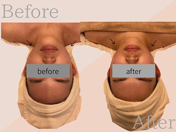 ファミーユ 名古屋店/【吸引後ケア、ダウンタイム】