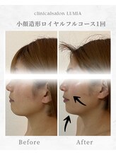 ルミア(LUMIA)/小顔造形ロイヤルフルコース１回