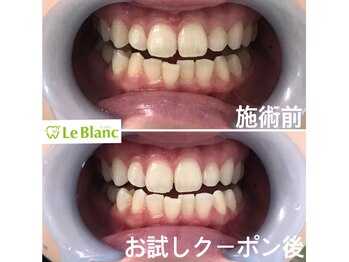 ルブラン 奈良店(Le Blanc)/安心で簡単なホワイトニング