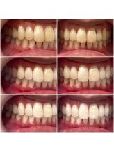 ホワイトニングショップ 高崎店/ビフォーアフターホワイトニング