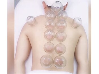 力道の写真/体の湿気を吸玉でデトックス！人気の全身整体と、吸玉施術のセットコース。施術後の効果が高い