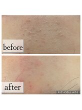 パル(PAL)/毛穴エクストラクション