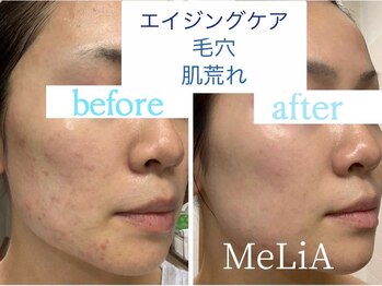 メリア(MeLiA)/群馬で唯一無二のニキビケア◎