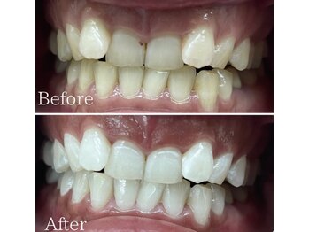 ホワイト 福岡博多店(WHITE)/ホワイトニング通い放題ビフォー