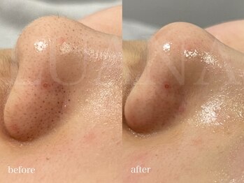 ルアナ(LUANA)/WAX＋毛穴洗浄