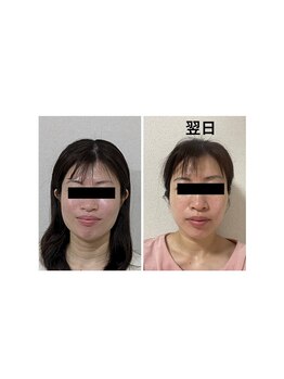 ミヤビ(miyabi)/小顔矯正