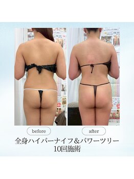 エスプレッソ(espresso,)/肩の盛り上がりもスッキリ!