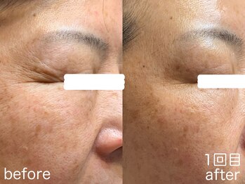 ハレオラ(HaleOla)/50代 素肌を育てる1stSTEP1回目