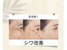 韓国ポリニューマーフェイシャル 【たるみ、引き上げ、小顔に効果最大】