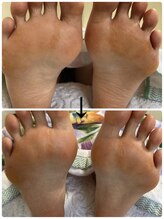 フロー(Froh)/ウオノメ多数