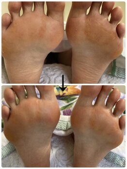 フロー(Froh)/ウオノメ多数