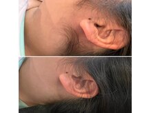 プロヴァンスの雰囲気(黒い毛穴汚れごっそり除去。(毛穴角栓除去))