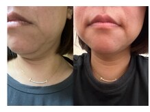 イアン(ian)/レモンボトル