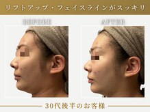 リムーン(REMOON.)/施術後の効果★30代後半のお客様