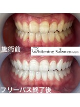ホワイトニングサロン 京都烏丸店/ホワイトニング施術例