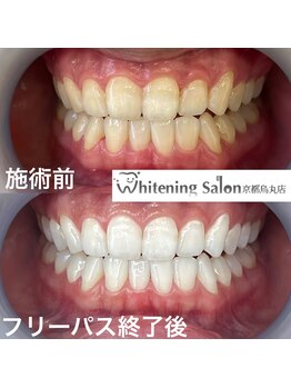 ホワイトニングサロン 京都烏丸店/ホワイトニング施術例