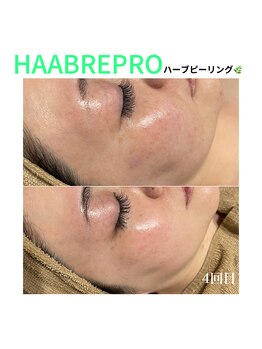 リブ(Lib)/本気の肌質改善♪