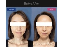 ナチュラル ビューティー ベルポート(natural beauty Bellport)/サーマルフラクショナル