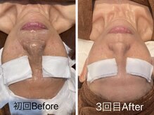 アイラブワン(eye love one)/光フォト【小顔/くすみ/毛穴】