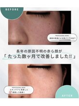 エーティーセンターラボ(At.center labo)/結果の出る赤ら顔プログラム