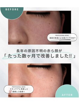 エーティーセンターラボ(At.center labo)/結果の出る赤ら顔プログラム