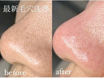 エクレ(eclat)/小さい毛穴も見逃しません！