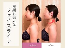 ティアラ/小顔コルギ