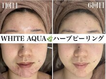 ホワイトアクア 浜松店(WHITE AQUA)/ハーブピーリング/ニキビケア