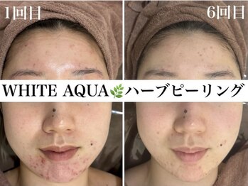 ホワイトアクア 浜松店(WHITE AQUA)/ハーブピーリング/ニキビケア