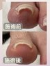 【フット】キャンペーン価格！お爪ケア＋巻き爪緩和レジスタンスプレート