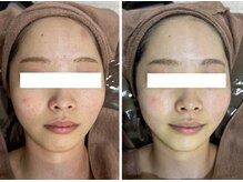 ホワイトアクア 岐阜店(WHITE AQUA)/ハーブピーリング/岐阜/ニキビ