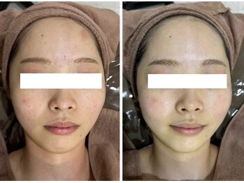 ホワイトアクア 岐阜店(WHITE AQUA)/ハーブピーリング/岐阜/ニキビ