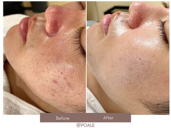 ポアレ 大宮店(POALE)/毛穴ケア症例【埼玉/大宮】