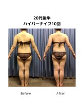 ビハダエステ 町田店(BIHADAエステ)/【B/A】20代後半ハイパーナイフ