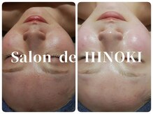 サロン ド ヒノキ(Salon de HINOKI)の雰囲気（大人の敏感肌さん必見☆剥離なしハーブピーリングで透明感UP！）
