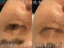 ブリエ(Briller)/シミ改善