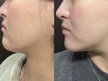 ピュアリー(purly)/【レモンボトル】Before After