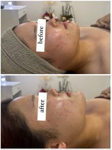 シエル(CieL)/トーンアップ&ニキビケア