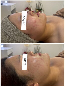 シエル(CieL)/トーンアップ&ニキビケア