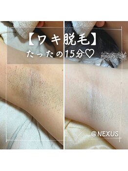 ネクサス(NEXUS)/【美肌ワキ脱毛】たったの15分♪