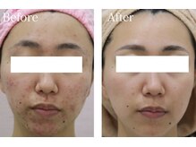 スマートポッシュ(Smart posh)/【ニキビケア】before→after