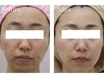 スマートポッシュ(Smart posh)/【ニキビケア】before→after