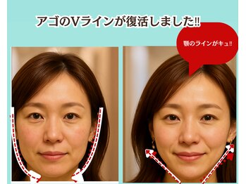 ピュアハリ/沖縄那覇美容鍼灸/小顔/たるみ