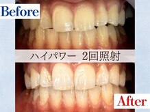 LBSホワイトニング 吉祥寺店/ホワイトニングビフォーアフター