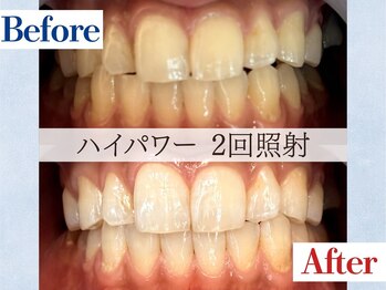 LBSホワイトニング 吉祥寺店/ホワイトニングビフォーアフター