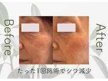 美成(vise)の雰囲気（VERUNAハーブピーリング｜ニキビ・ニキビ後の色残り・シワ・シミ）