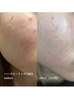 マティダ(Mathida)/【Revi】ハーブピーリング1回目