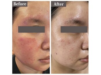 ビ ボーテ(美 Beaute)/ニキビケア・毛穴ケア肌トラブル