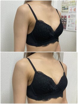 バーディー(BIRDIE)/施術１回/２０代