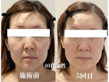 サピュイエ(S'appuyer)/しわ、たるみケアで5歳若見えに